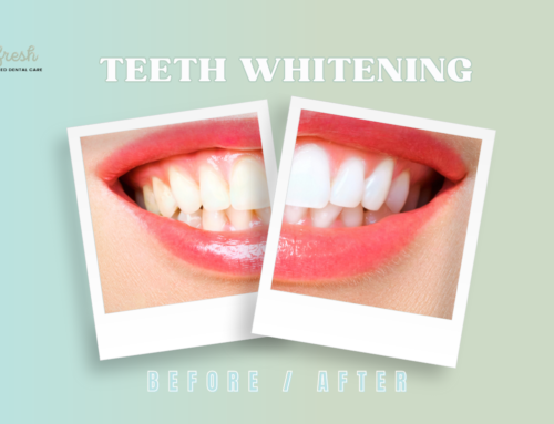 Teeth Whitening – Coral Gables, Florida