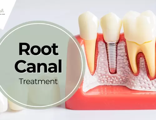 Root Canal in Coral Gables, FL